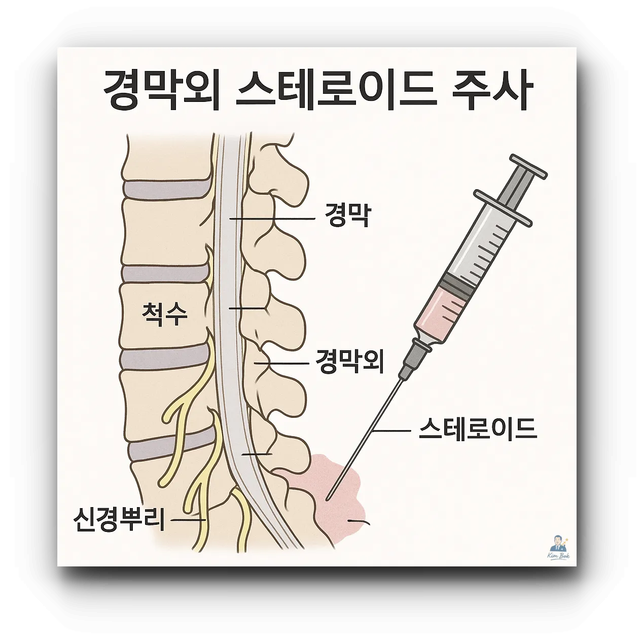 경막외-스테로이드-주사-시술-방법