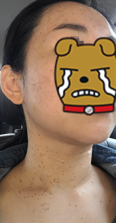 편평사마귀 시술 2일 차