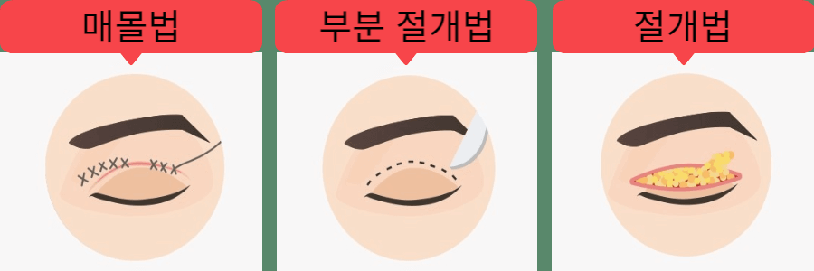 쌍꺼풀 종류