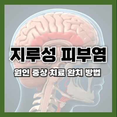 지루성 피부염 샴푸, 지루성 피부염 연고, 두피 지루성 피부염, 얼굴 지루성 피부염 치료, 지루성 피부염 완치 방법, 말라세지아 관리, 비듬 제거 샴푸