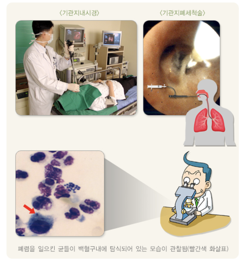 객담 검사