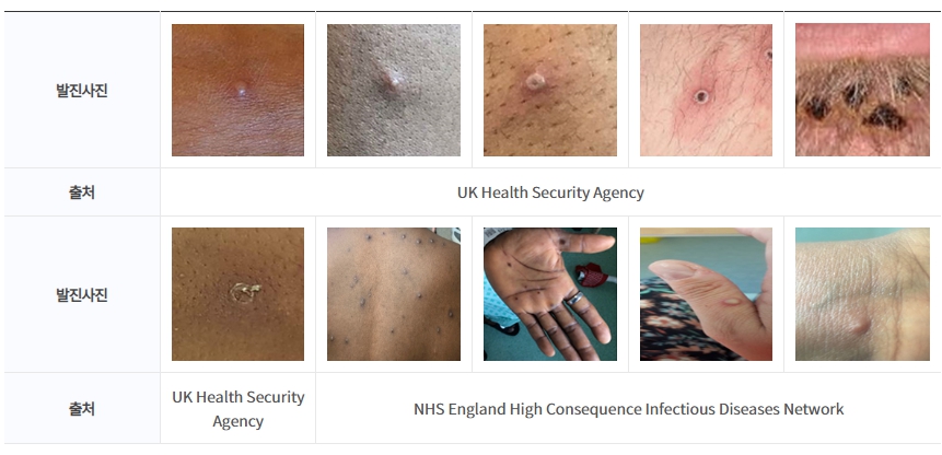 앰폭스(Mpox-원숭이 두창) 발진 사진