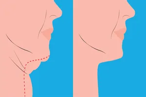 턱관절-통증-스트레칭