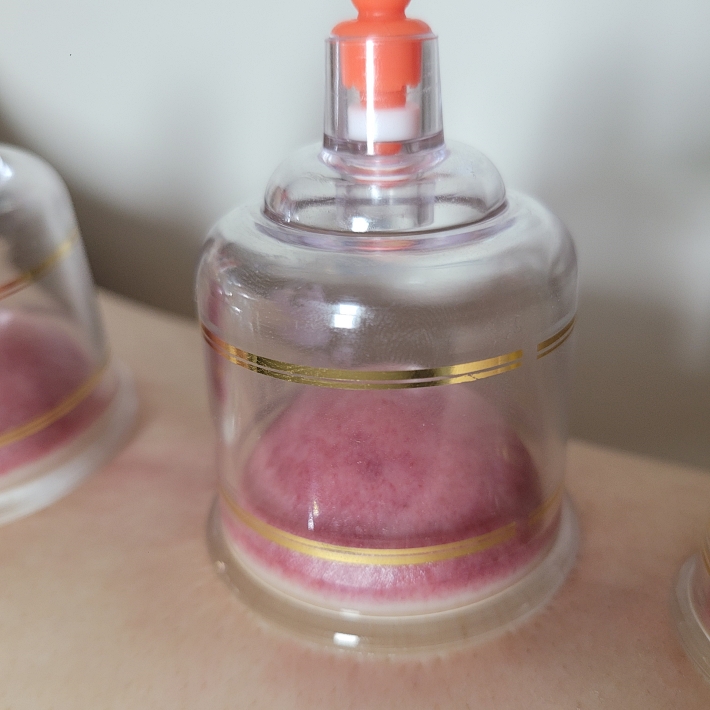 부항을 뜨면 근육이 미세하게 파열되며 혈류가 개선되며 멍이 든다