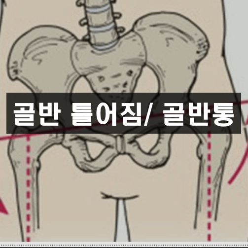 골반 틀어짐/ 골반통
