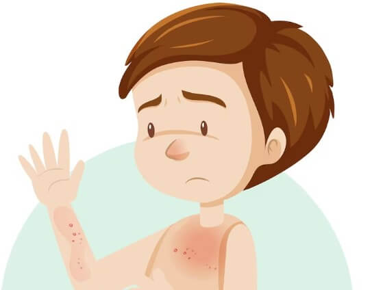 땀띠-원인-증상-없애는-방법-6
