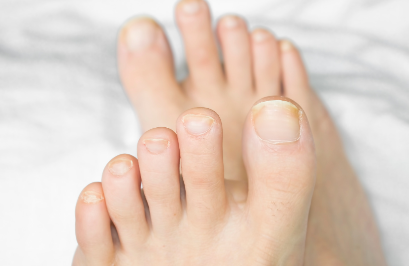 무좀 약 없이 치료하는 법