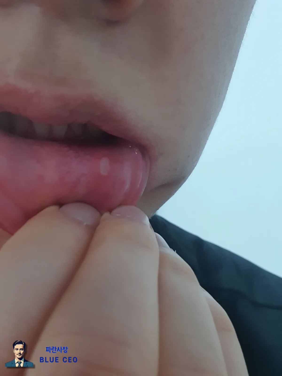 입속-구내염-크기-인증샷-매우-고통스러운-상황