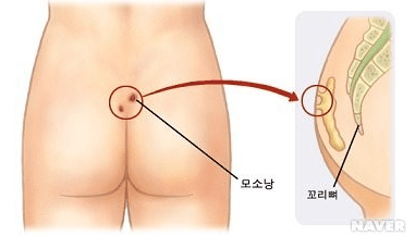 모소낭-증상-위치