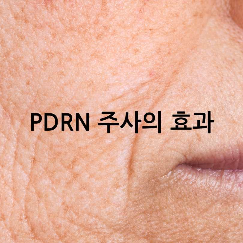 PDRN 주사란? 효과부터 부작용, 가격