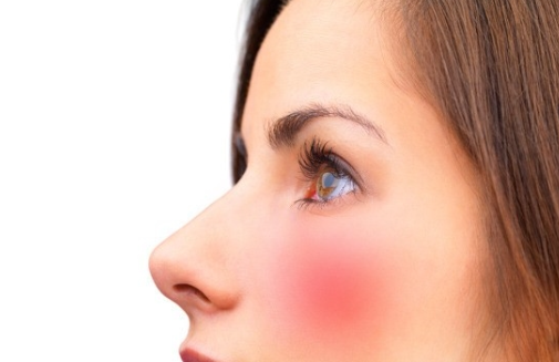 안면홍조증의 진단