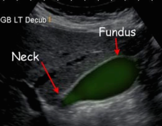 담낭 해부학 (GB anatomy )