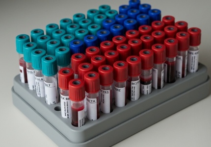 전립선암 초기증상