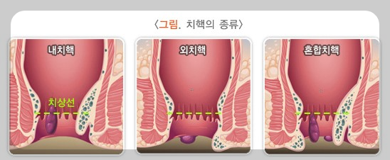 치핵의 종류 사진
