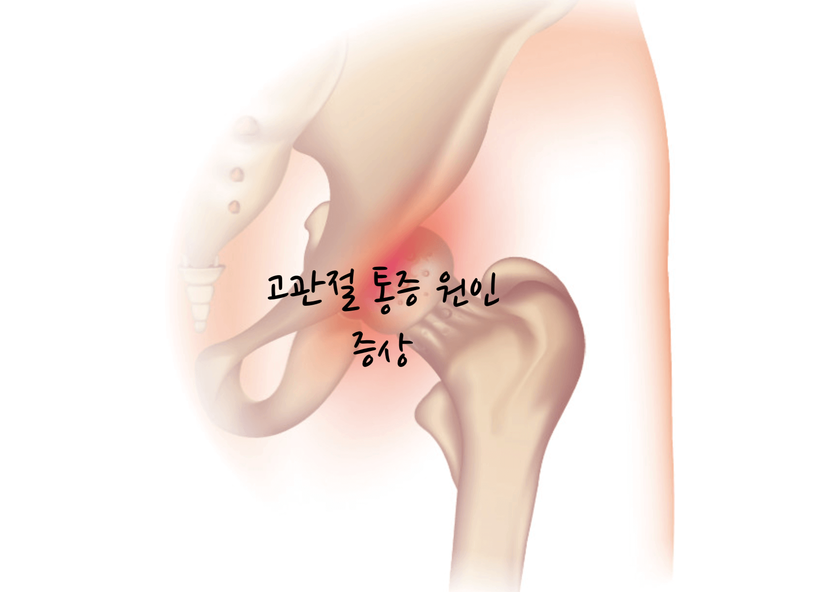 고관절 통증