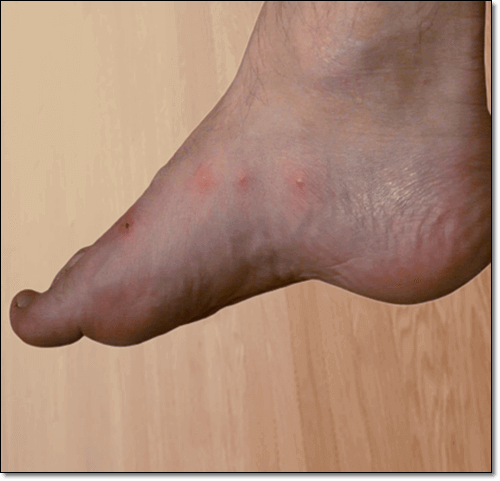 구진성 두드러기 증상