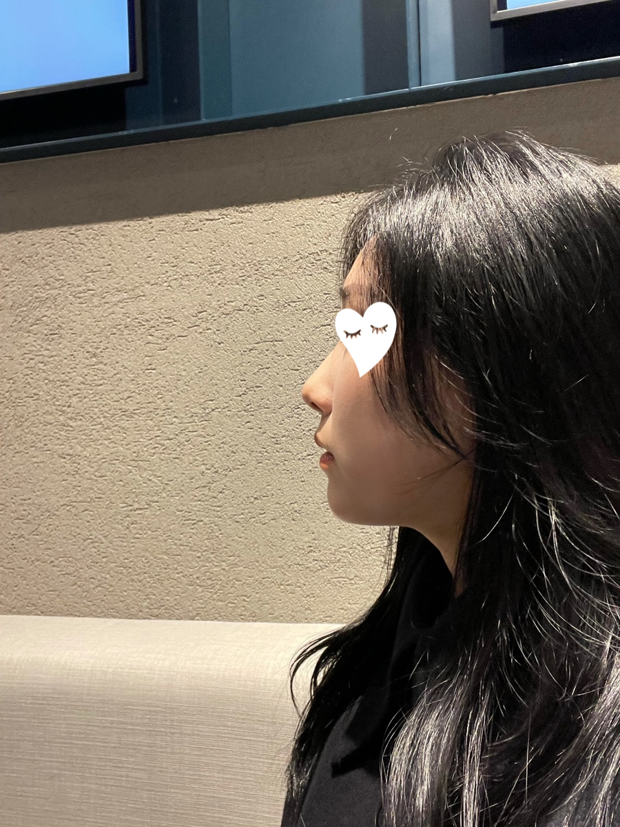 이중턱 보톡스 후기