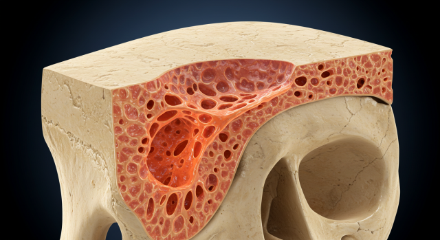 골밀도가 낮아진 여성의 뼈 단면