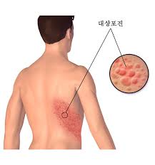 대상포진 초기증상과 치료법