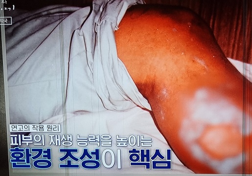 화상연고-작용-원리-비법