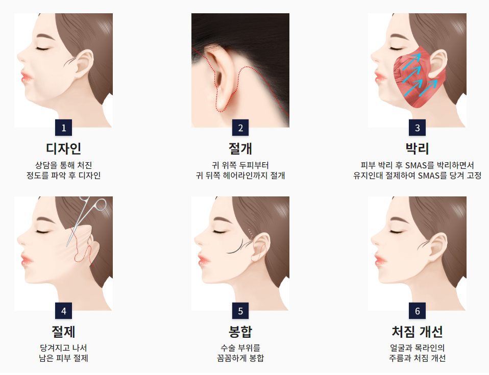 안면거상 수술이란, 효과, 후기, 비용, 주의사항 총정리