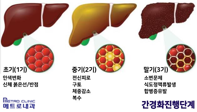 간경화-간암-진행-단계