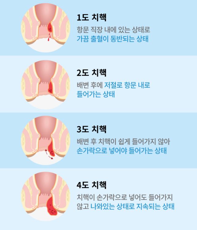 치핵의_단계별_상태