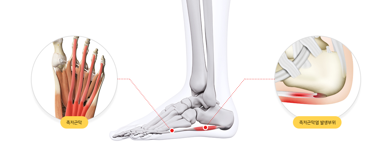 족저근막염 증상