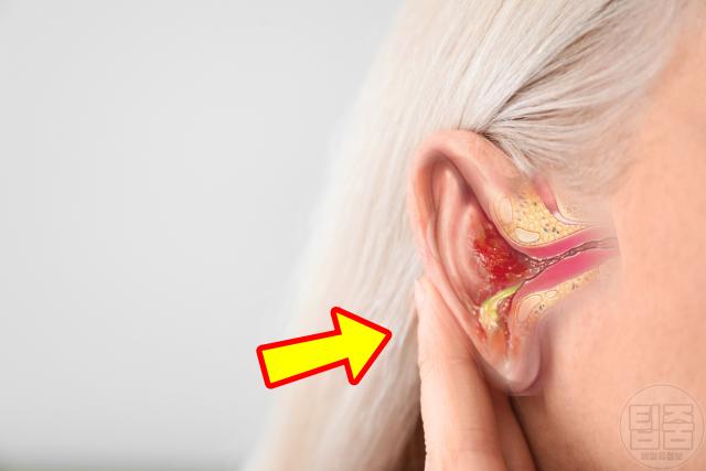 귀에서 물나옴 외이도염 증상