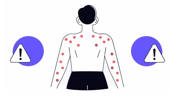 햇빛알레르기 치료 과정