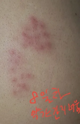 대상포진 치료방법에 대한 총정리 건강 질병관리_18