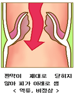 하지정맥류-다리가-붓는-이유