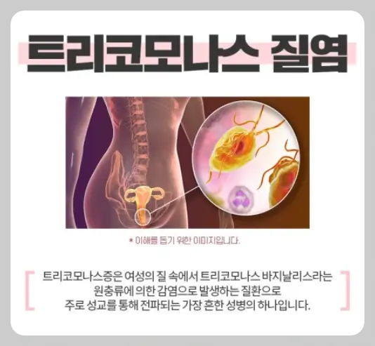 트리코모나스질염