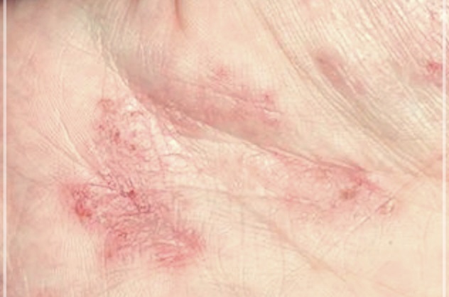 손가락 껍질 벗겨짐 원인과 해결 방법