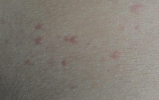 콜린성 두드러기 원인