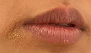 박탈성구순염-입가로-번짐