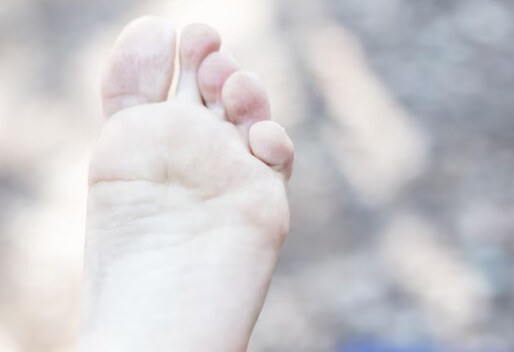 수포형-무좀-증상-생기는-원인-치료법-4