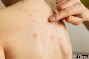 대상포진 예방접종 가격(최저가 확인&amp;#44; 무료접종 대상)과 관련하여 대상포진 발병하여 포진이 생긴 사람 사진