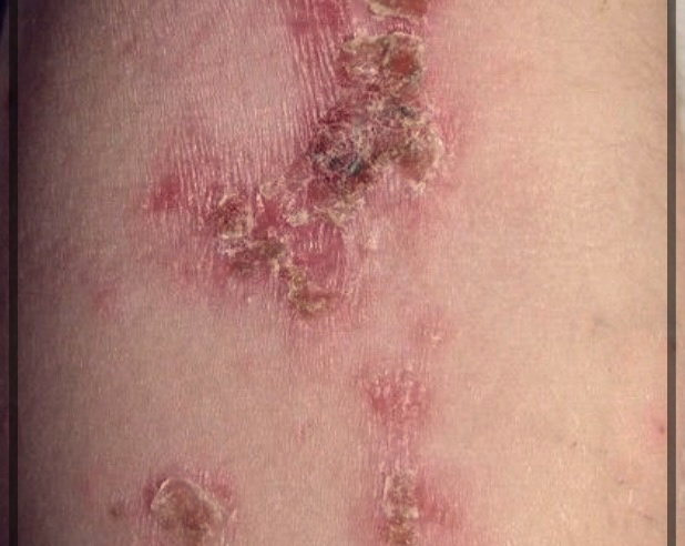 성인 농가진: 원인, 증상, 및 치료 방법