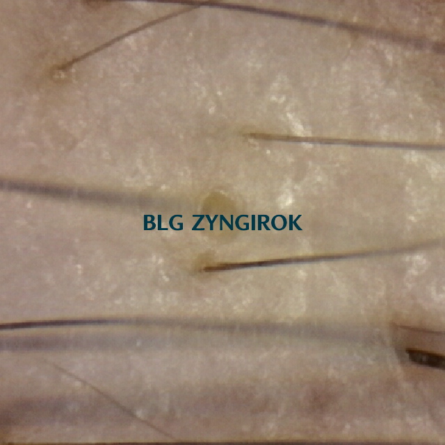 탈모 극복 프로젝트 - 탈모약 복용 33주차 오른쪽 M자 부위 두피사진 모습이다.