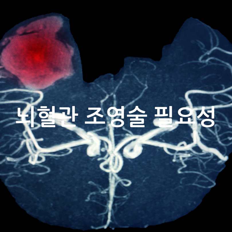 뇌혈관 조영술