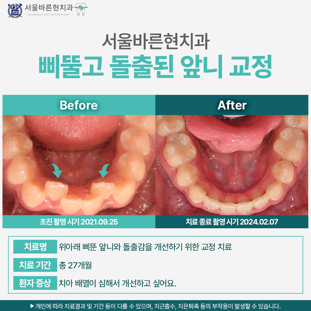 부산치아교정