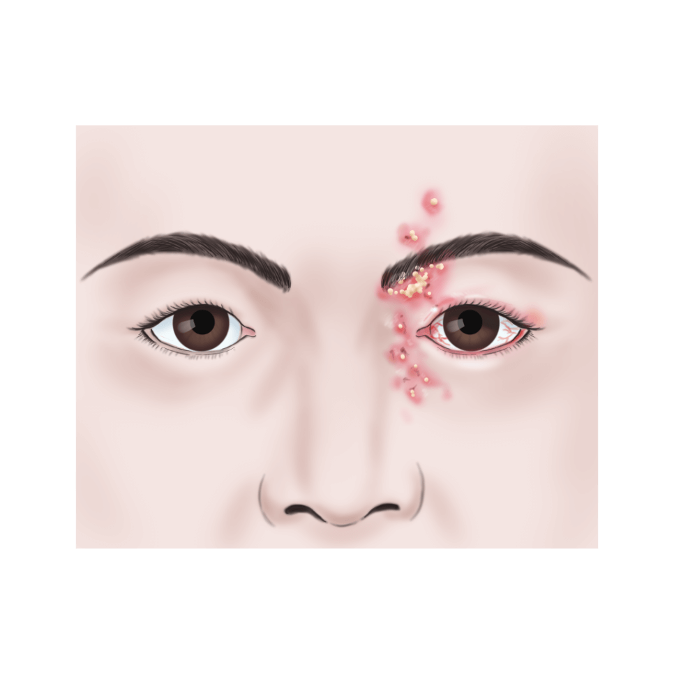 대상포진 피부병변