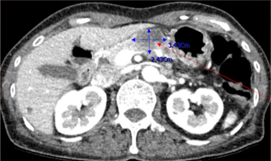 사람의 신체 부위 중 췌장 엑스레이 사진
