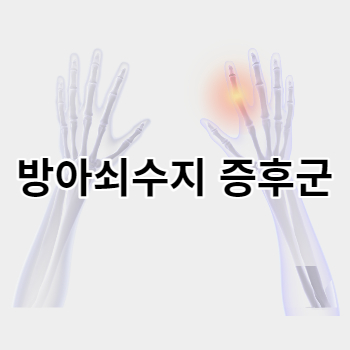 방아쇠수지 증후군