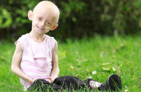 소아조로증 치료방법