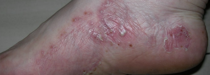 발 물집 생기는 이유1