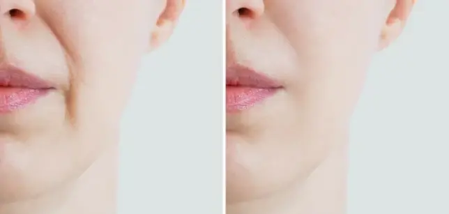 팔자주름
