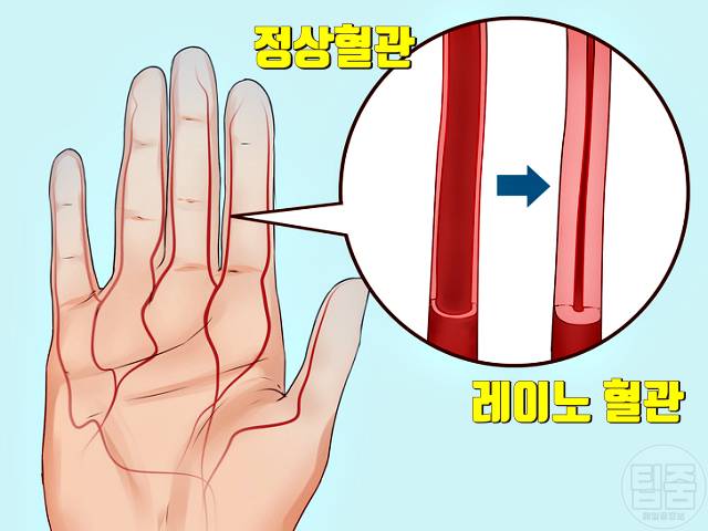 손가락 주름 병 질환 레이노