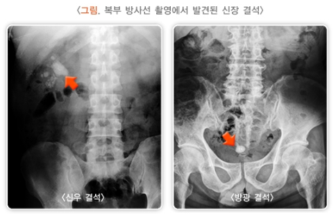 복부 엑스레이 사진